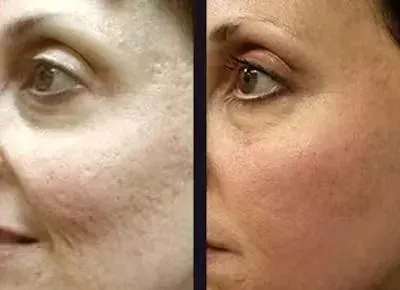Före och efter microneedling i ansiktet