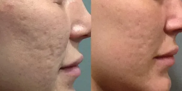 Före och efter microneedling mot akneärr i ansiktet