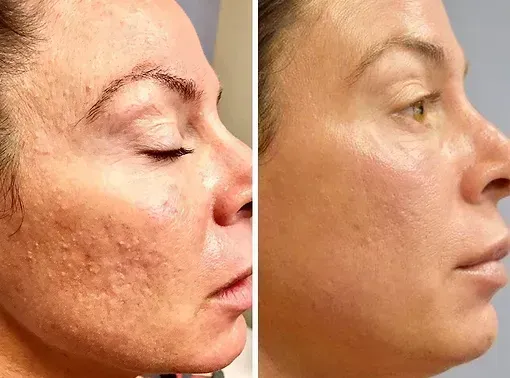 Före och efter microneedling mot ojämn hudton i ansiktet